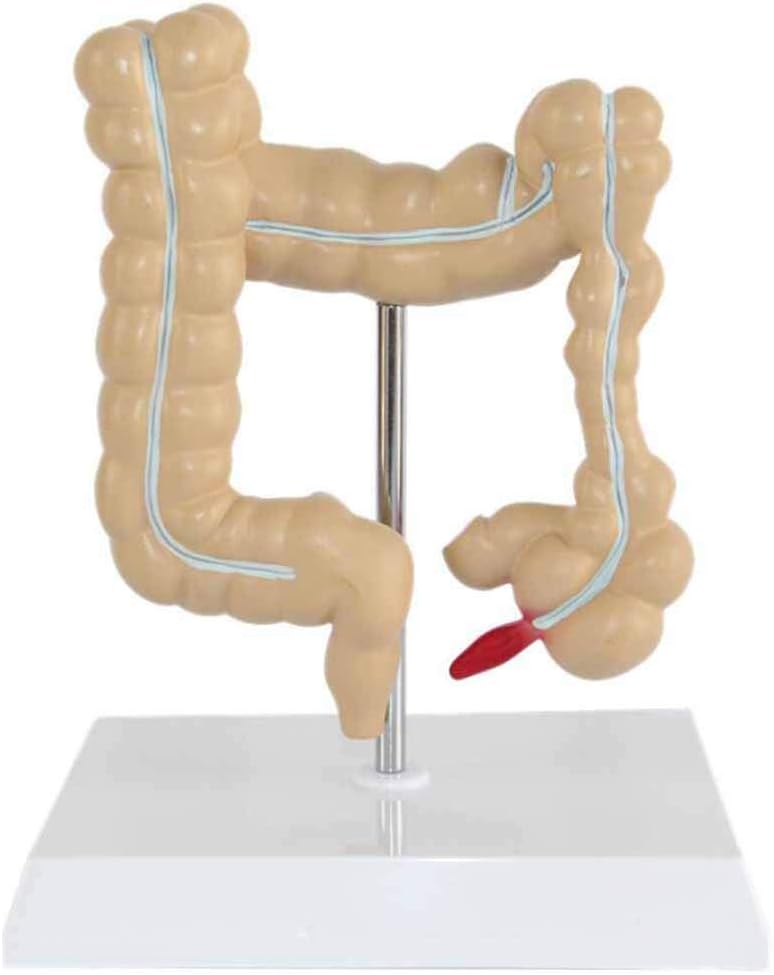 Modelo Anatómico de Colon con Patologías Comunes