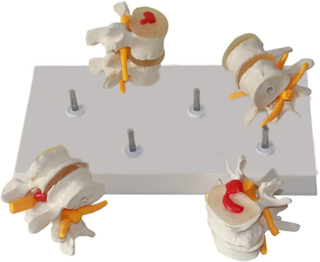 Vértebras Lumbares Patologia Degenerativa