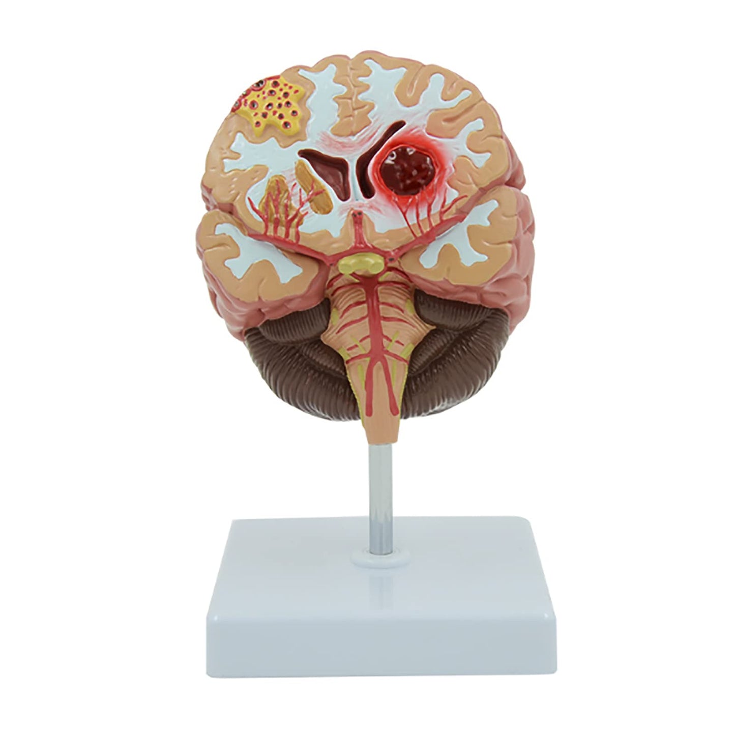 Cerebro Modelo Patologías