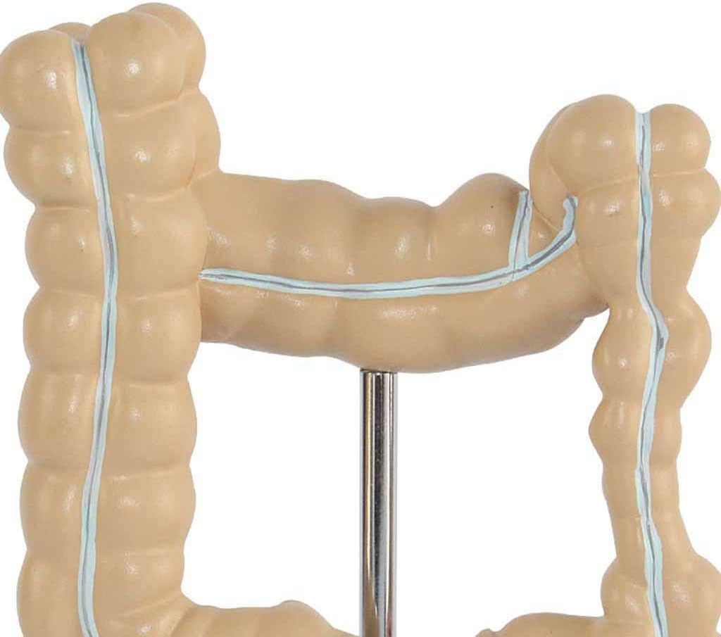 Modelo Anatómico de Colon con Patologías Comunes