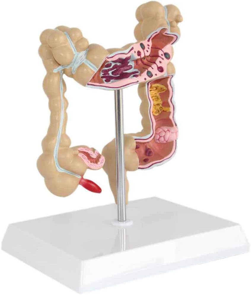 Modelo Anatómico de Colon con Patologías Comunes