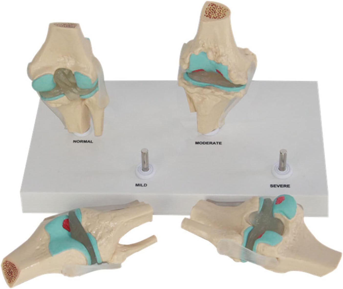 Rodilla Patología 4 etapas de Degeneración Articular