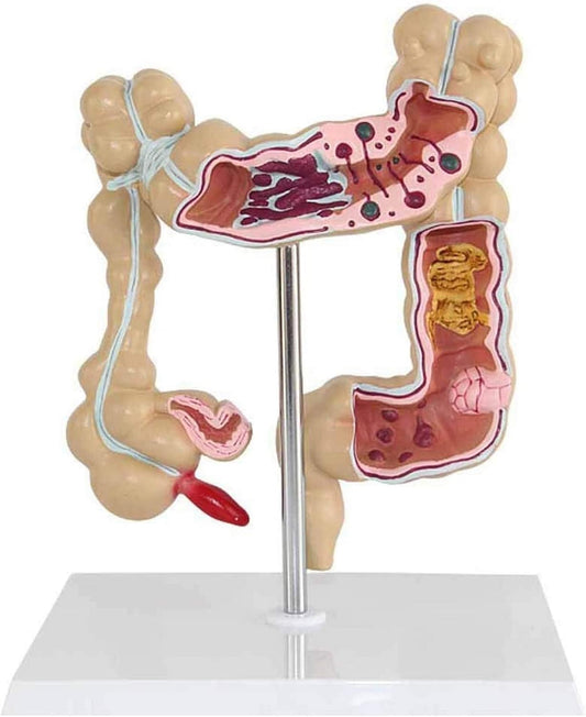 Modelo Anatómico de Colon con Patologías Comunes