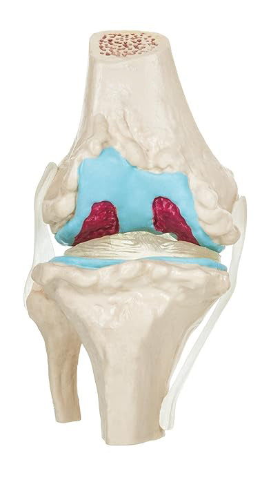 Rodilla Patología 4 etapas de Degeneración Articular