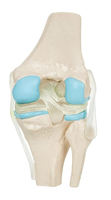 Rodilla Patología 4 etapas de Degeneración Articular