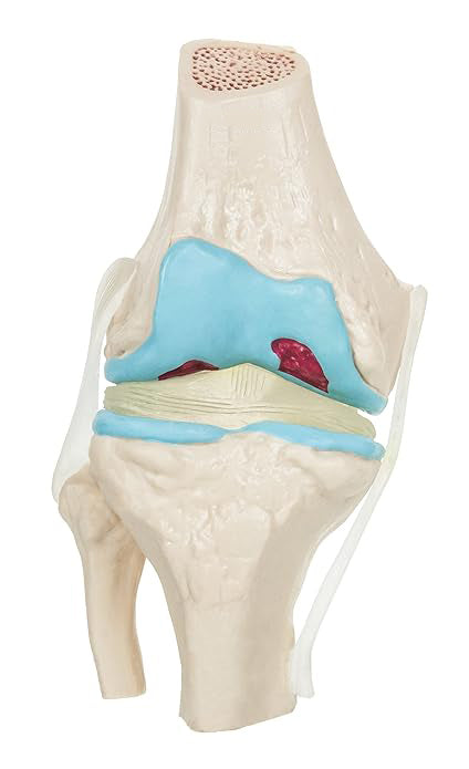 Rodilla Patología 4 etapas de Degeneración Articular