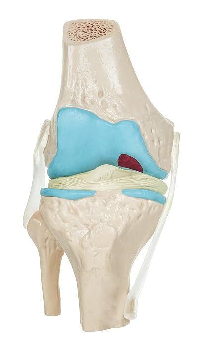 Rodilla Patología 4 etapas de Degeneración Articular