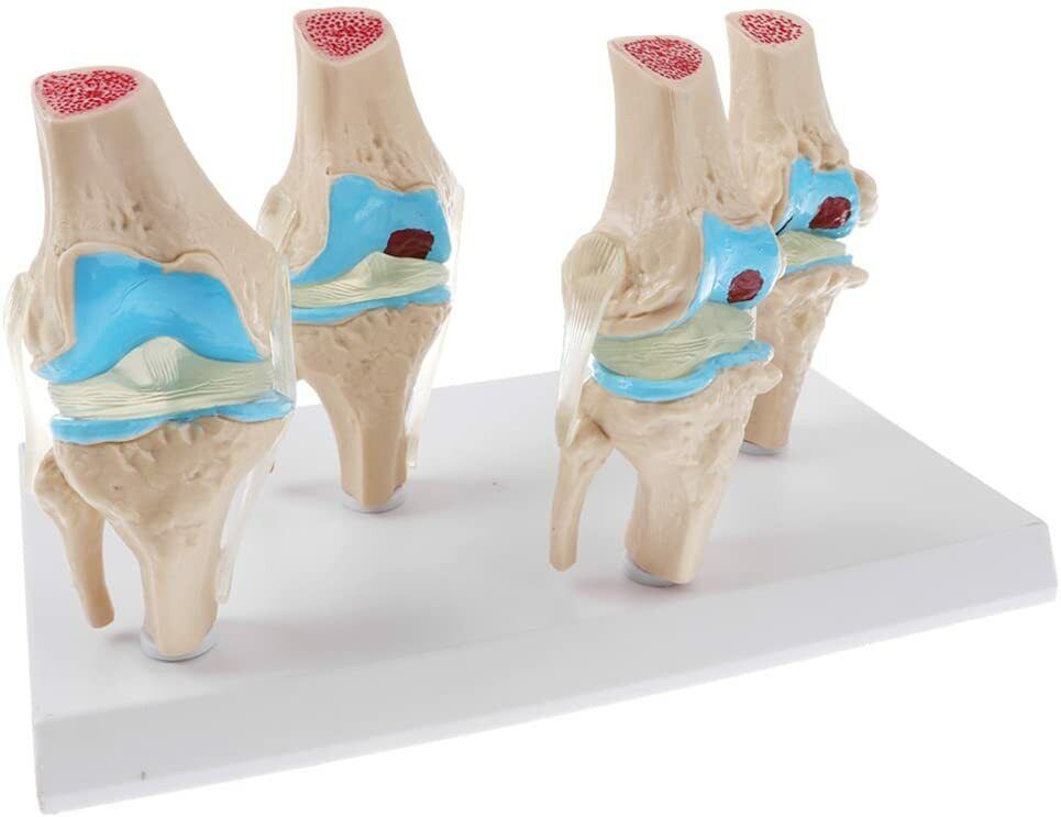 Rodilla Patología 4 etapas de Degeneración Articular