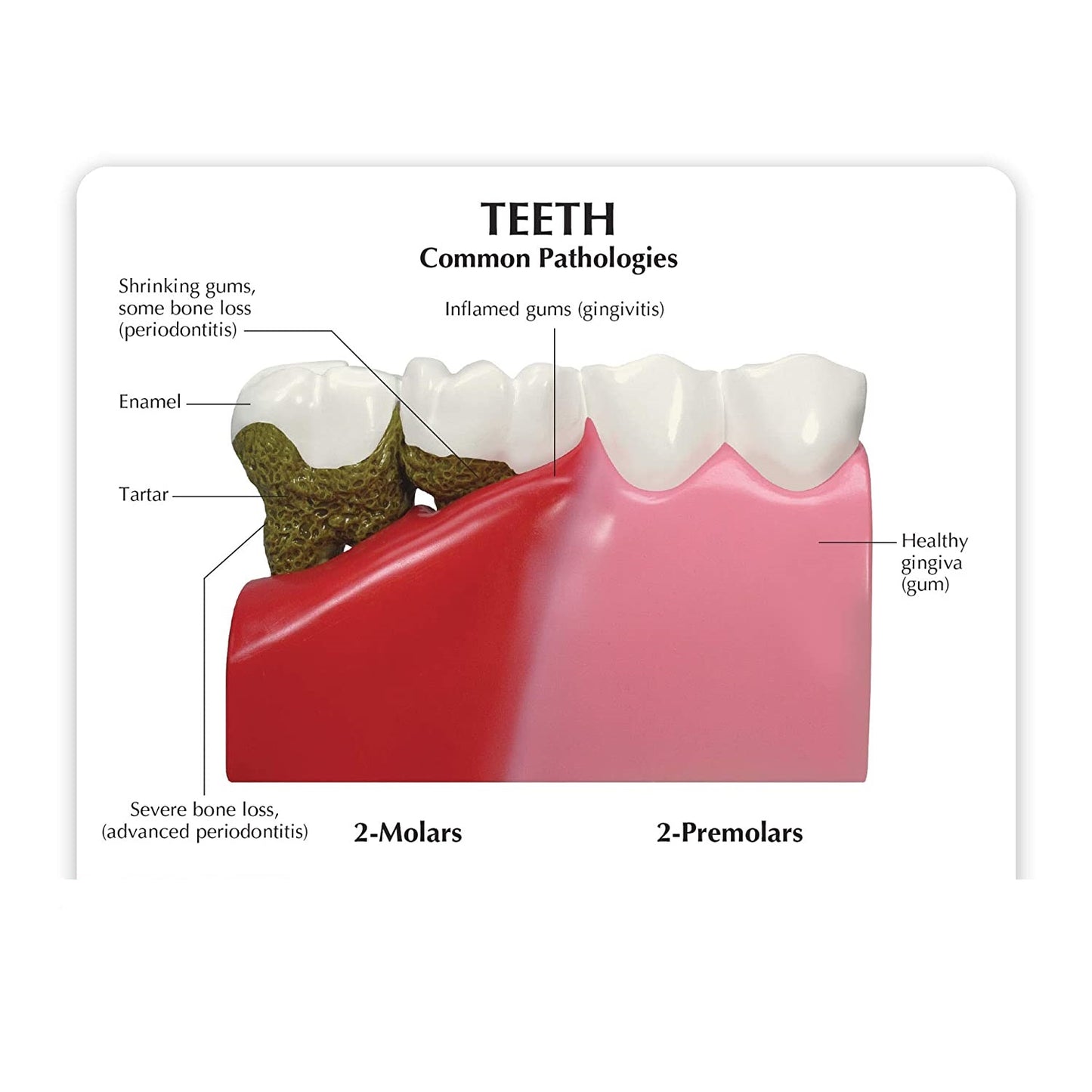 Dientes Patología Oral Enfermedad Periodontal